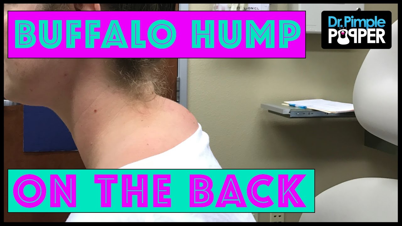 Not a TRUE “Buffalo Hump” Lipoma with Dr Pimple Popper