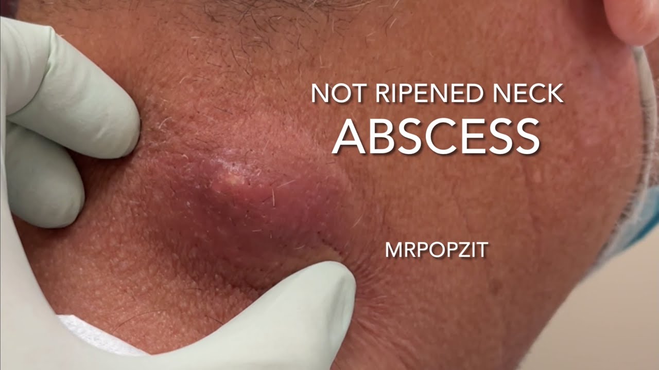 Not ripened neck abscess. Painful firm nodule with deep pocket on neck. I+D with packing. MrPopZit