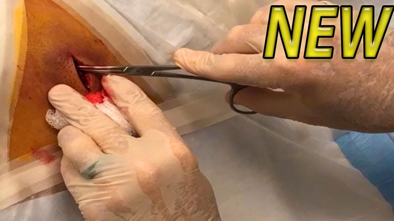 Numbers’ Infected Back Cyst Procedure!  BRAND NEW