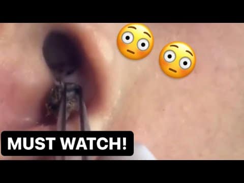 Oddly Satisfying Blackhead Removal | Pimple Popping | WeViraNow