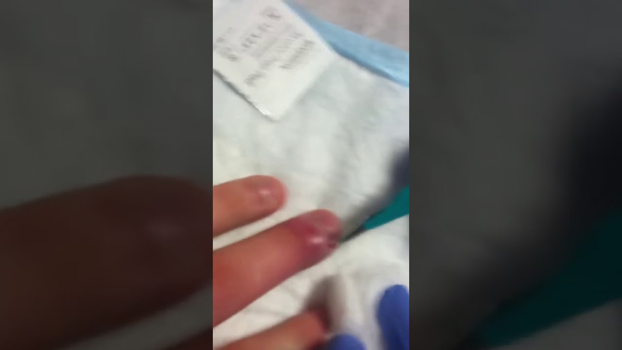 Oddly Satisfying Cyst Pop