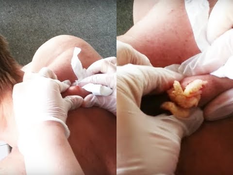 Oddly Satisfying Cyst Popping  – Compile Me