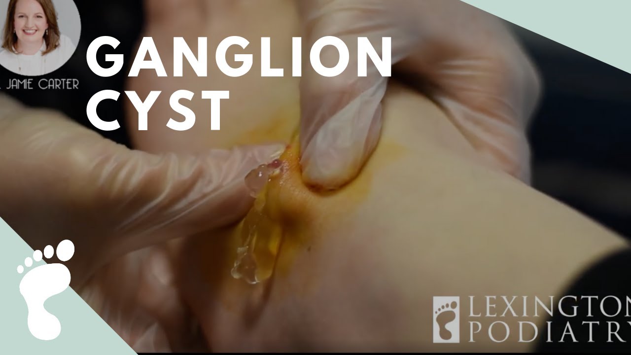 "Oddly Satisfying" | Oozing Ganglion Cyst