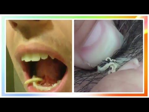 Oddly Satisfying Pimple/Blackhead Popping Video ||Relaxing Music||  (Part 15)