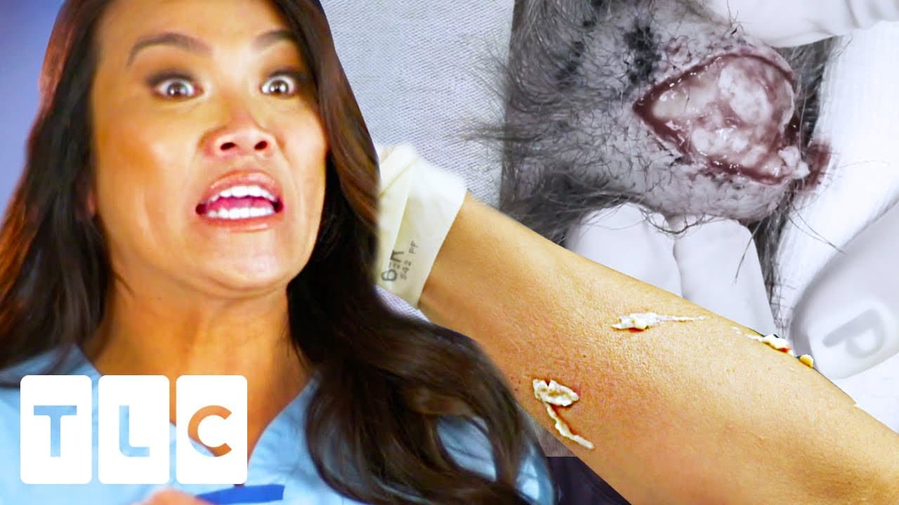 "Oh My God!": A Massive Pilar Cyst Explodes On Dr Lee | Dr. Pimple Popper