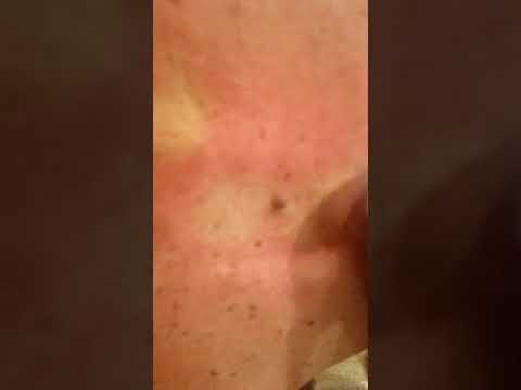 Old dude, massive blackhead popped! Thick, old stuff.  Virgin squeeze! Pimple popping