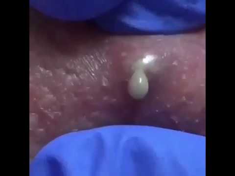 OMG !!! (Look at that yumminess) Pimple Popping subscribe ?