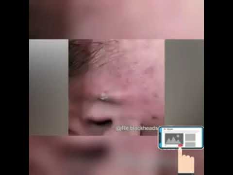 OMG! PIMPLE POPPING 2022 ? Warning ⚠️ Blackheads removal   Cyst   wound   abscess   don't puke ?