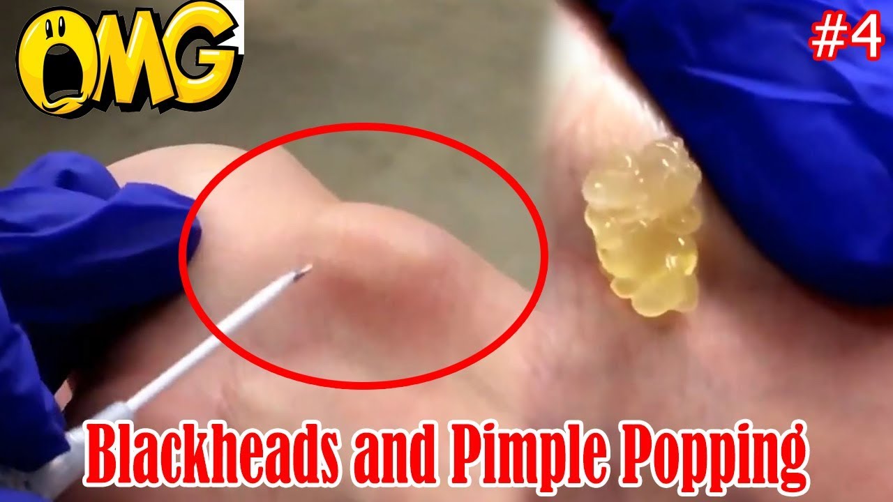 OMG Removal Blackheads and Pimple Popping | Pimples & Cysts |