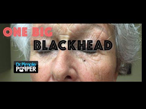 One big blackhead just for Cliffo in Queensland, AU!! Listen to HOTFM Townsville!!