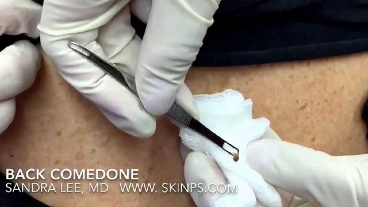 One blackhead extracted: Short, but sweet.  For medical education- NSFE.