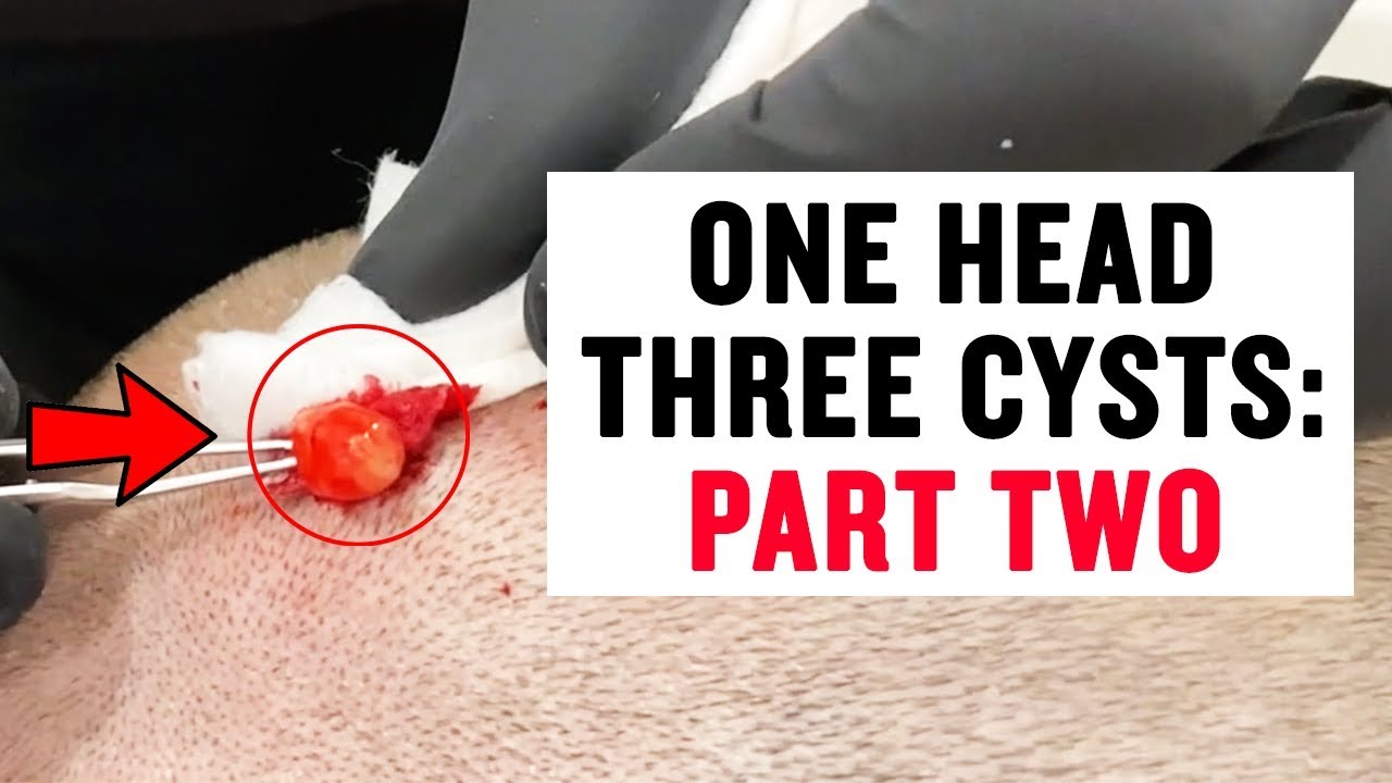 ONE HEAD, THREE CYSTS: PART TWO