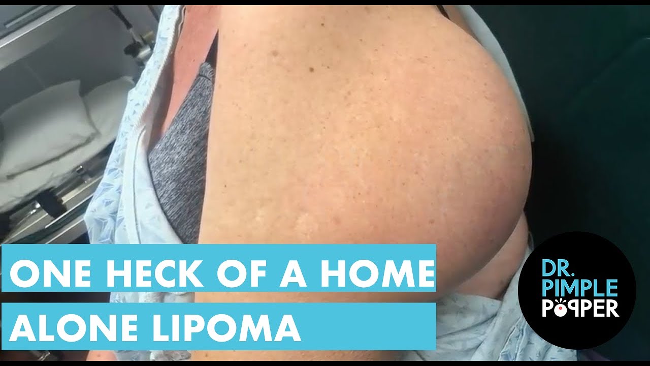 One Heck of a Home Alone Lipoma ?