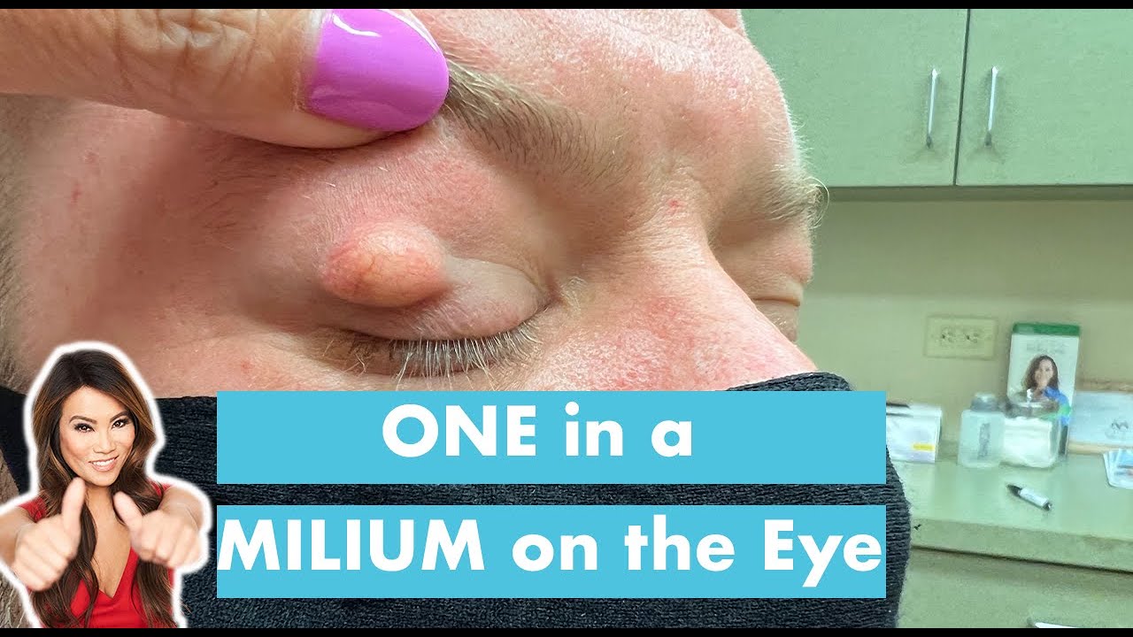 One in a Milium on the Eye