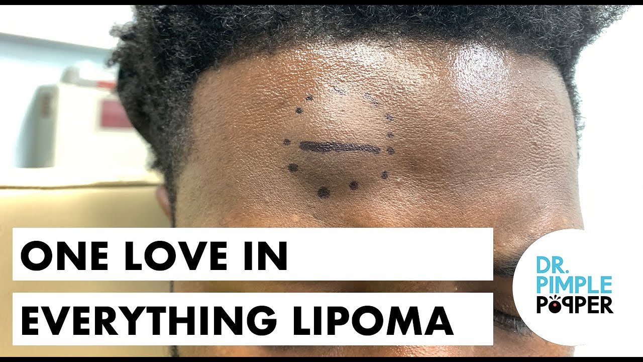 One Love in Everything… Lipoma