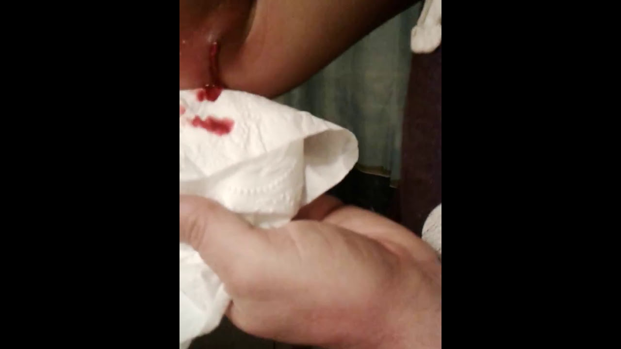 *ONE MASSIVE* Whitehead, stomach turning, zit popping video.