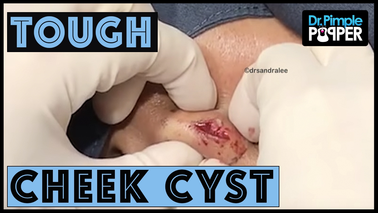 ONE.  Tough.  Cyst-uation.  Dr Pimple Popper.
