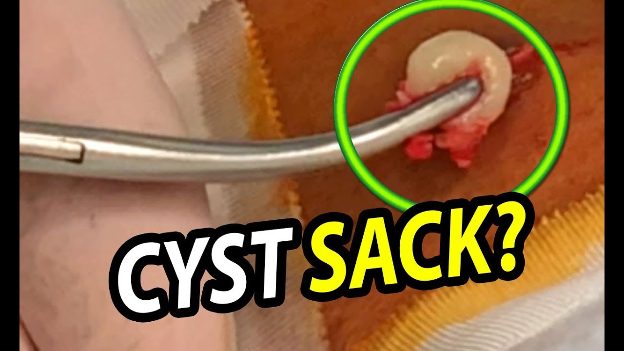 Onion Neck Cyst Sack!   Just the Sack!