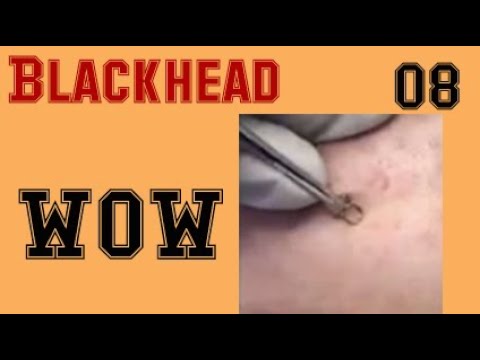 Open & Closed Blackheads Removal – The best Pimple Popping Videos