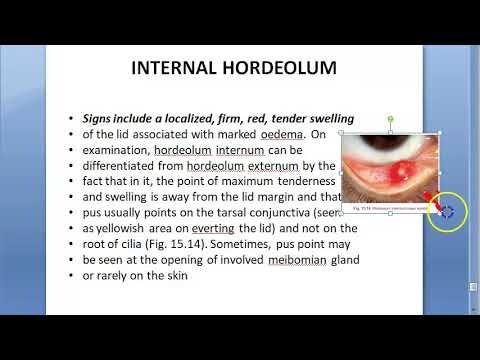 Ophthalmology 378 Internal Hordeolum Meibomian gland infection