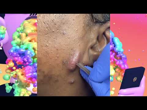 Ouça o seu coração | Popping huge blackheads and Pimple Popping – Best Pimple Popping Videos