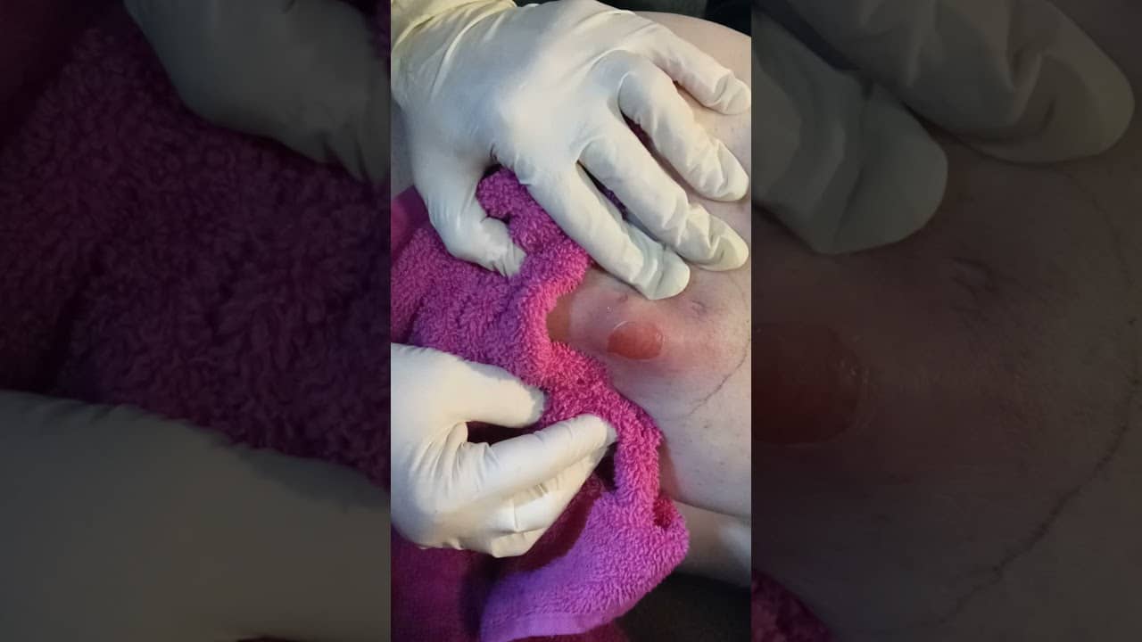 Ouch!!Squeezing Infected Abscess At Home