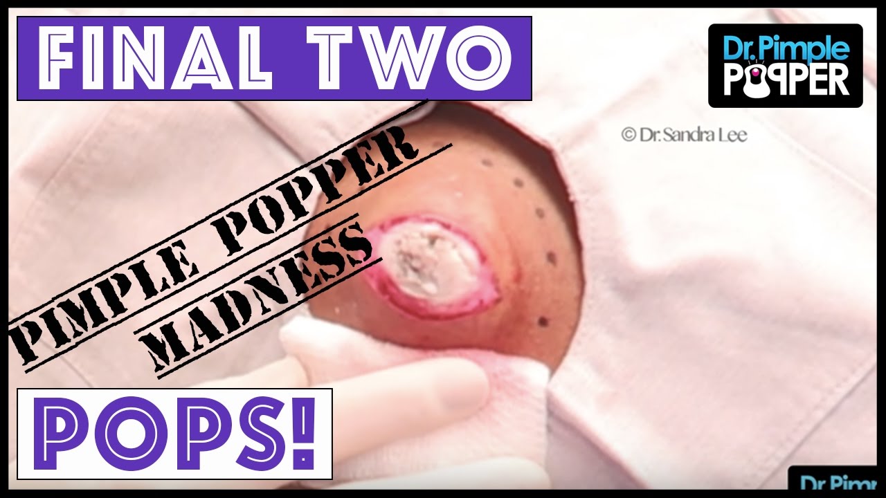 Our FINAL TWO POPS for you – PIMPLE POPPER MADNESS!!