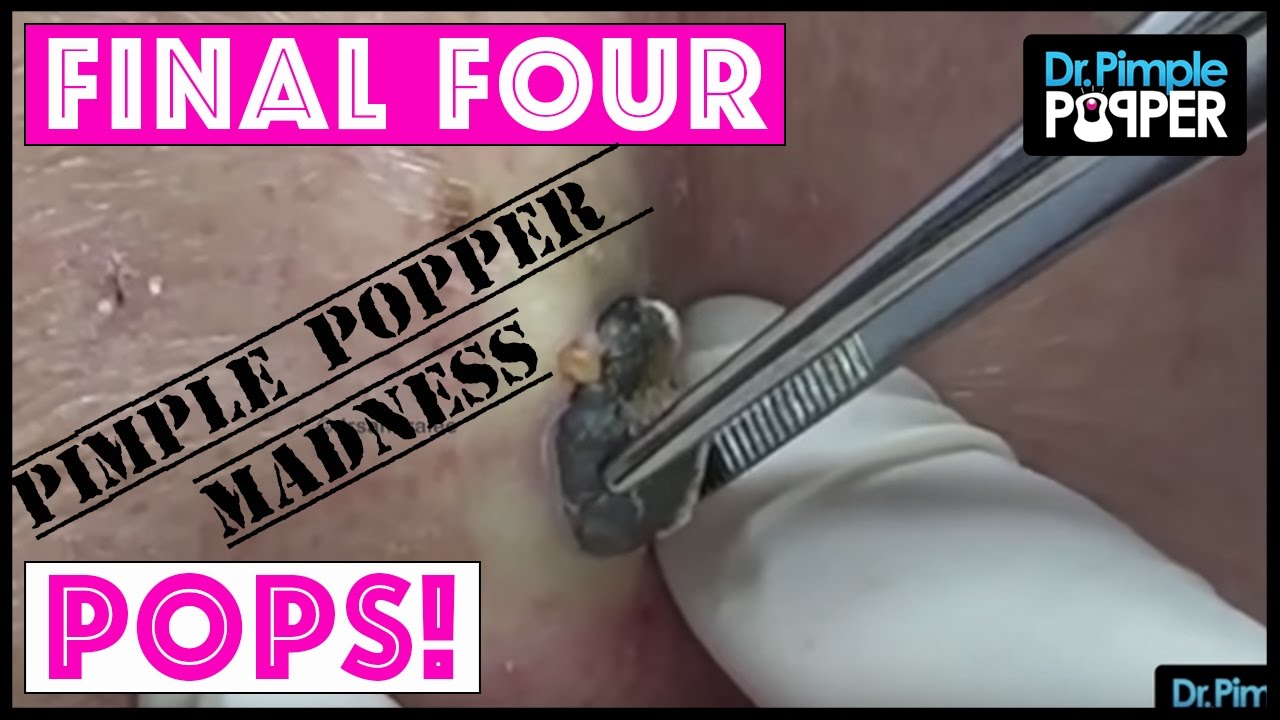 Our FOUR FINAL POPS for you – PIMPLE POPPER MADNESS!!