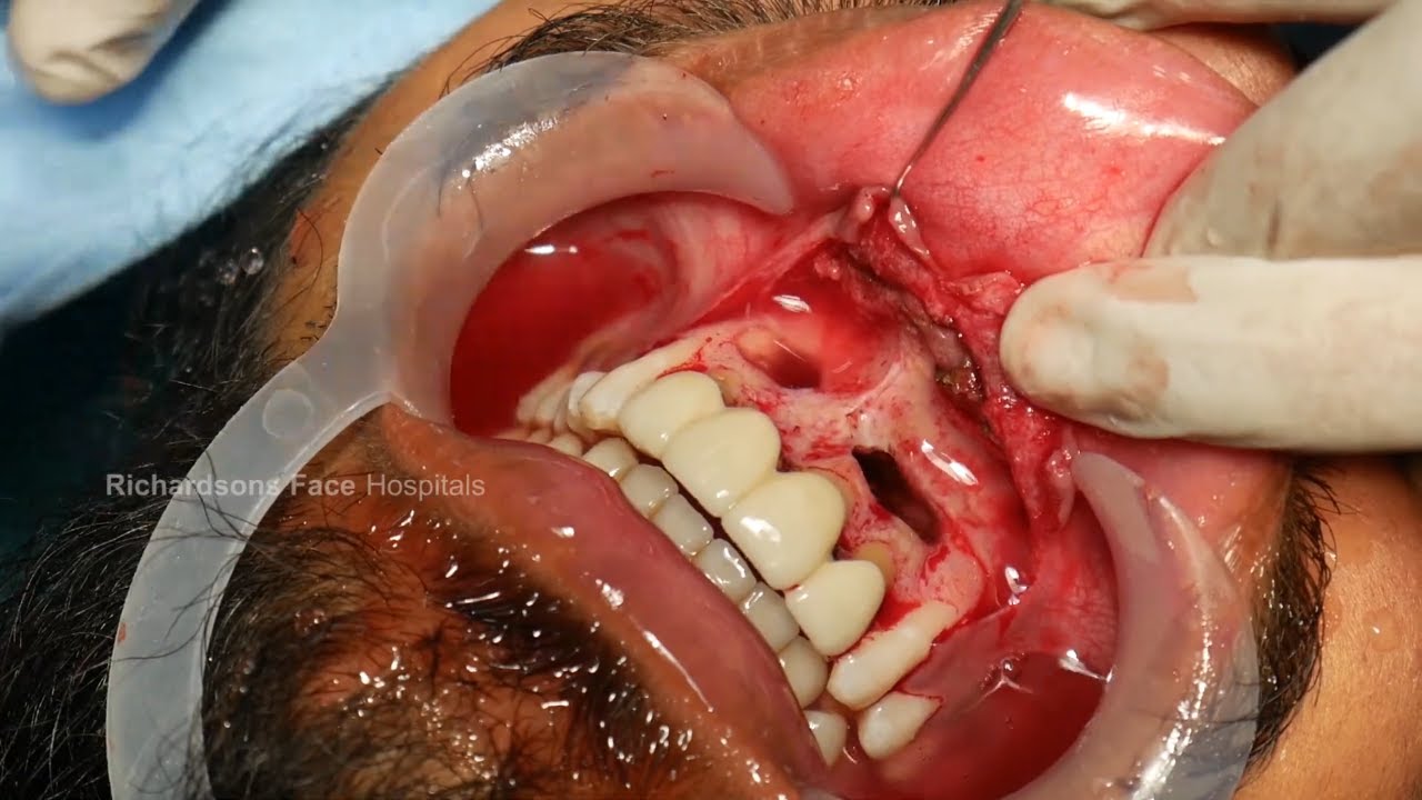 Painful Cyst Removed from Mouth – Surgical Method