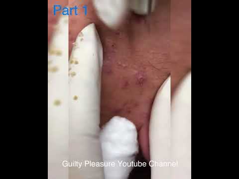 (Part 1) Satisfying pimple popping – Pimple field on the cheeks