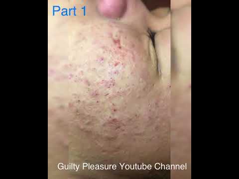 (Part 1) The most disgusting and satisfying pimple popping – Blackhead and cyst removal