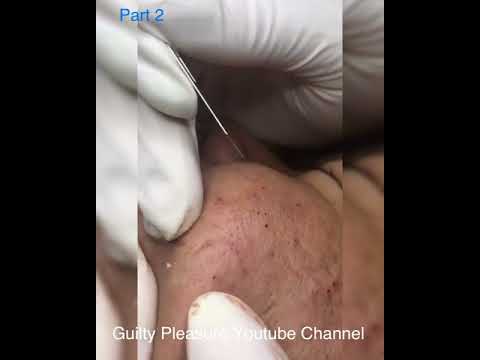 (Part 2) Removing Pimple on the old facial skin – Tiny pimple popping