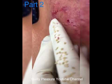 (Part 2) Satisfying pimple popping – Pimple field on the cheeks