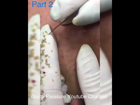 (Part 2) The most disgusting and satisfying pimple popping – Blackhead and cyst removal