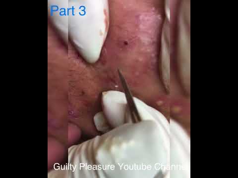 (Part 3) Satisfying pimple popping – Pimple field on the cheeks