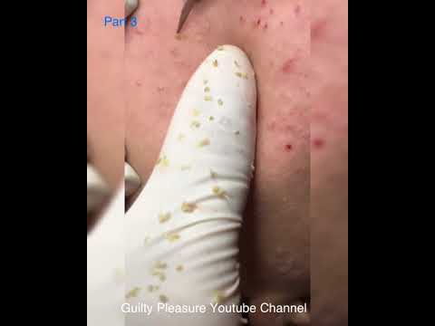 (Part 3) That’s what you call Blackhead Extractions – Man pimple popping