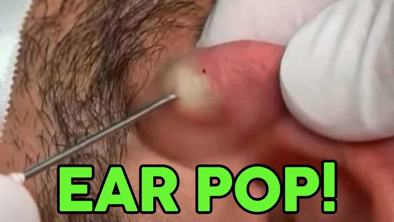 Penbrook's Ear Cyst Gets Busted