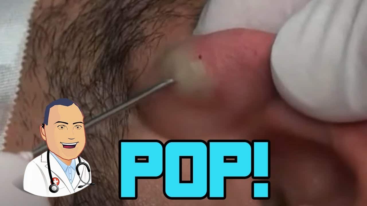 Penbrook's Ear Cyst Gets Popped