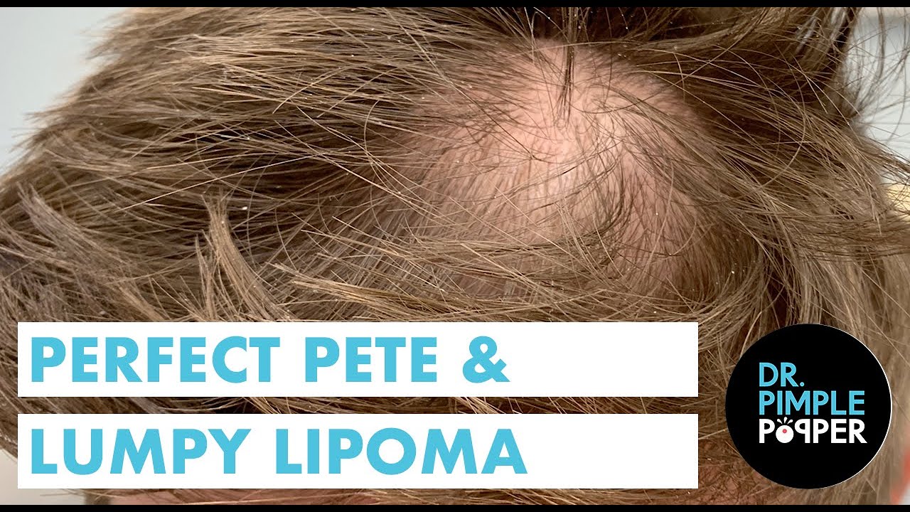 Perfect Pete and Lumpy Lipoma