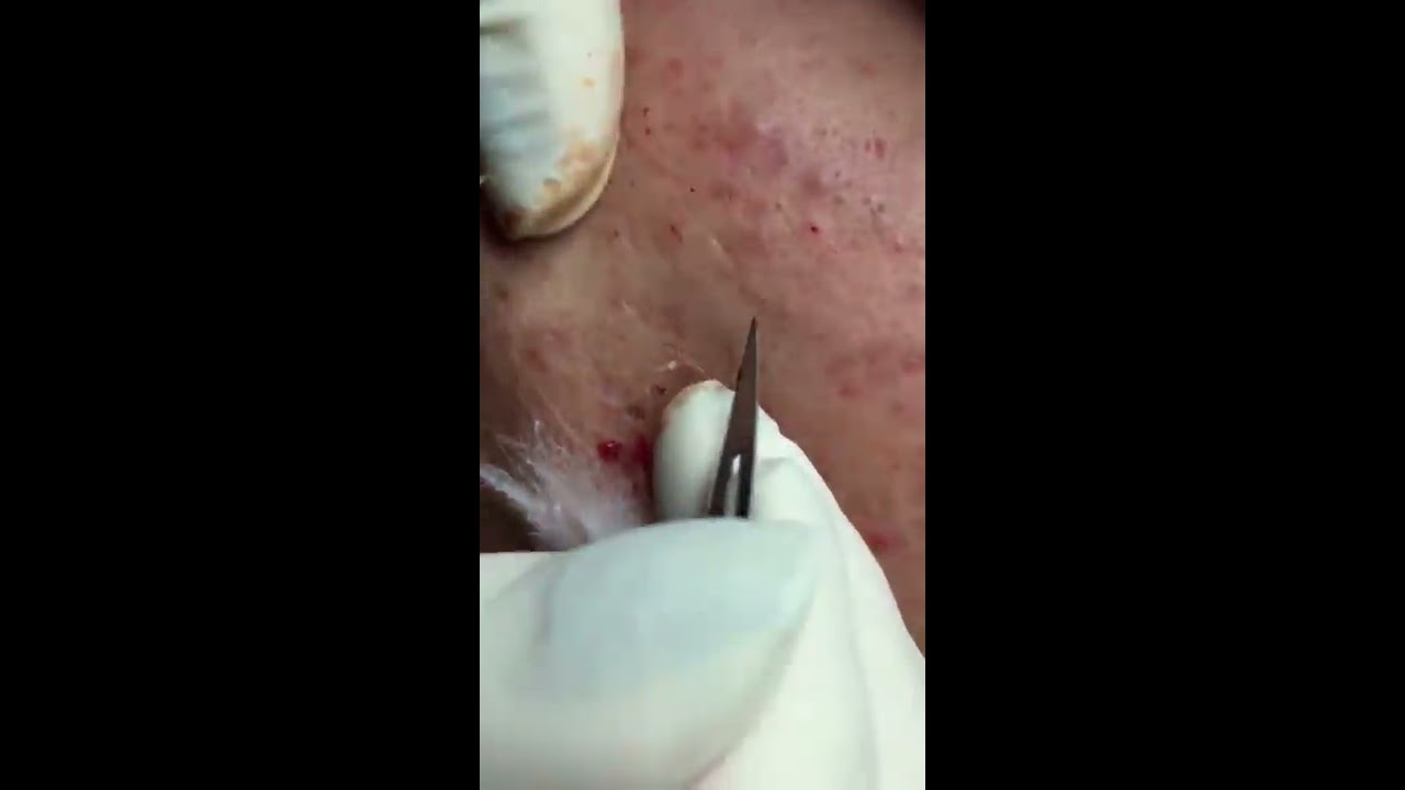 Perfect pimple popping