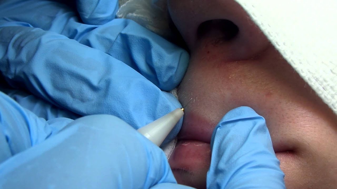 Permanent hair removal of vellus hair in the middle of the upper lip.