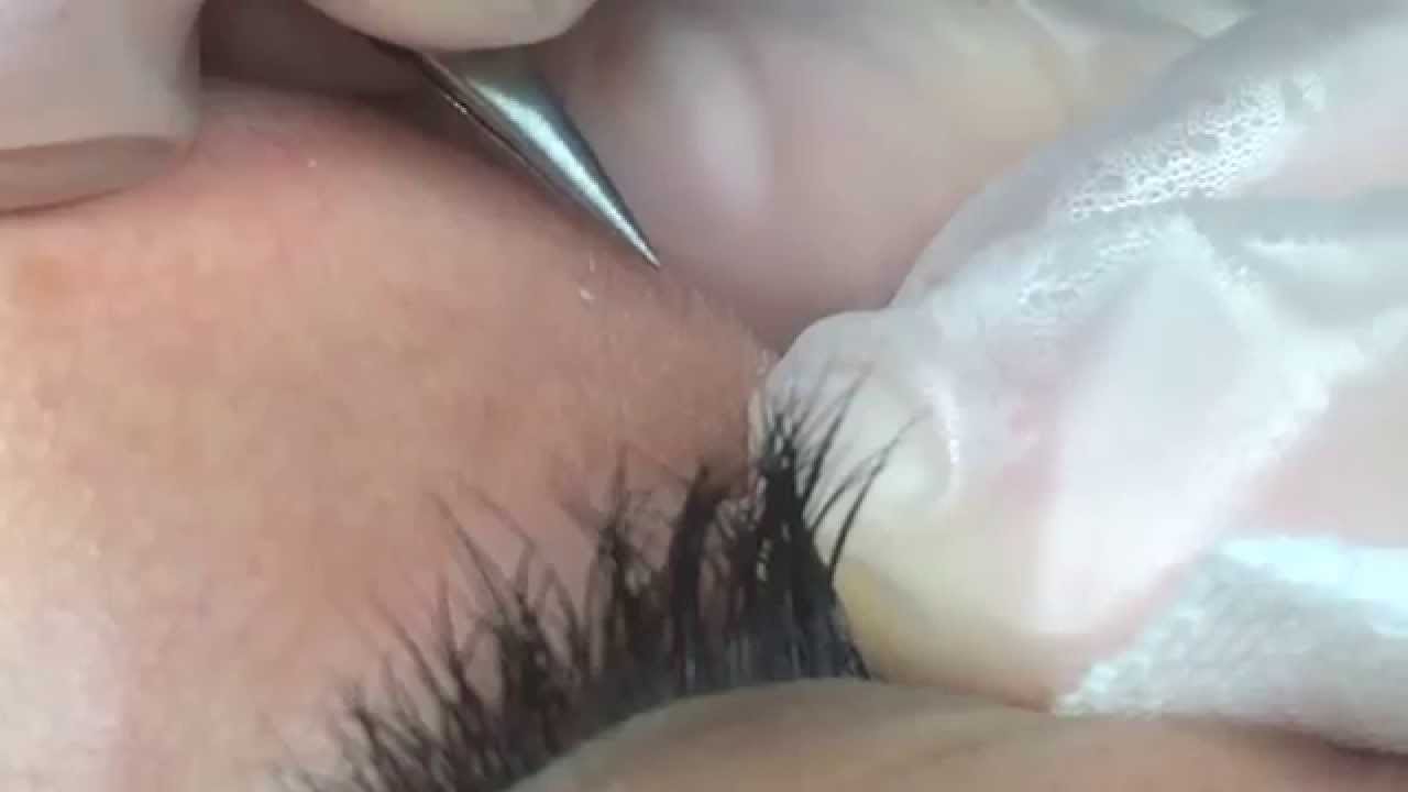 Permanent Hair Removal Under the Eyes