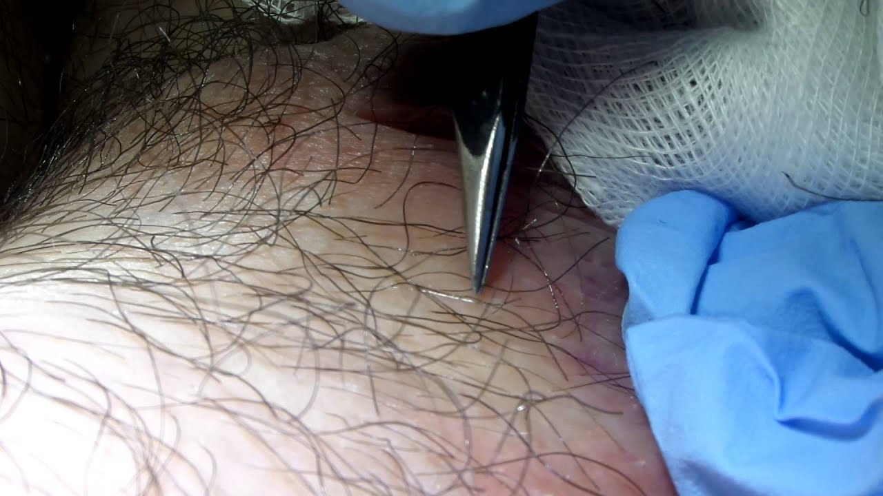 Permanent Hair Removal with Spectrum of Instantron
