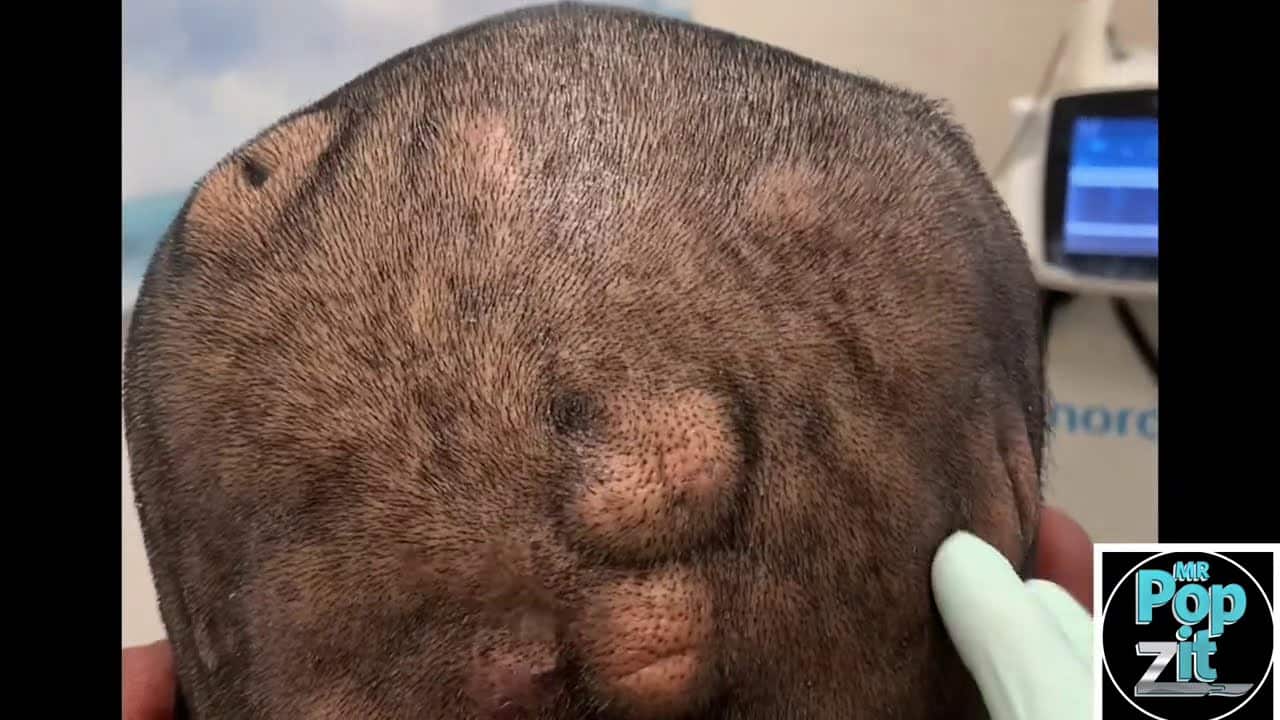 Pilar cyst #11. Only a few left on his scalp. Cyst pops out of its pocket with minimal pressure.