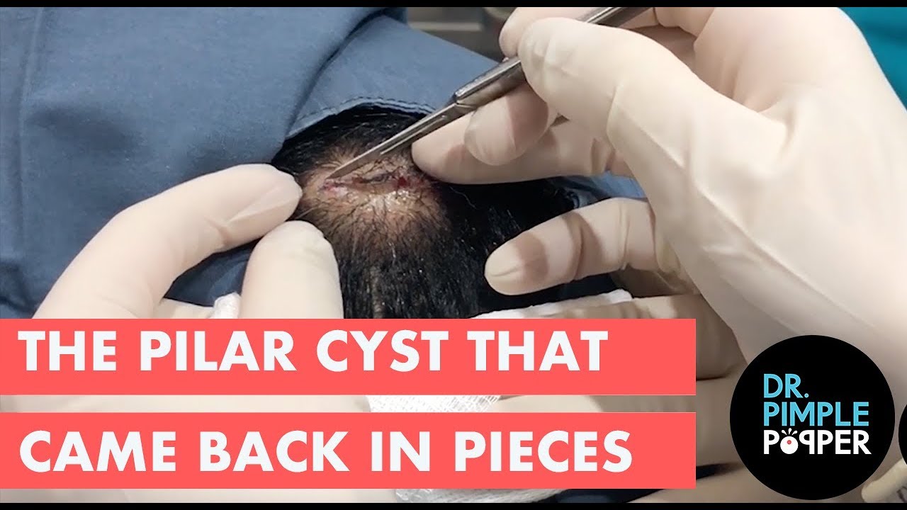 Pilar Cyst that Came Back in Pieces