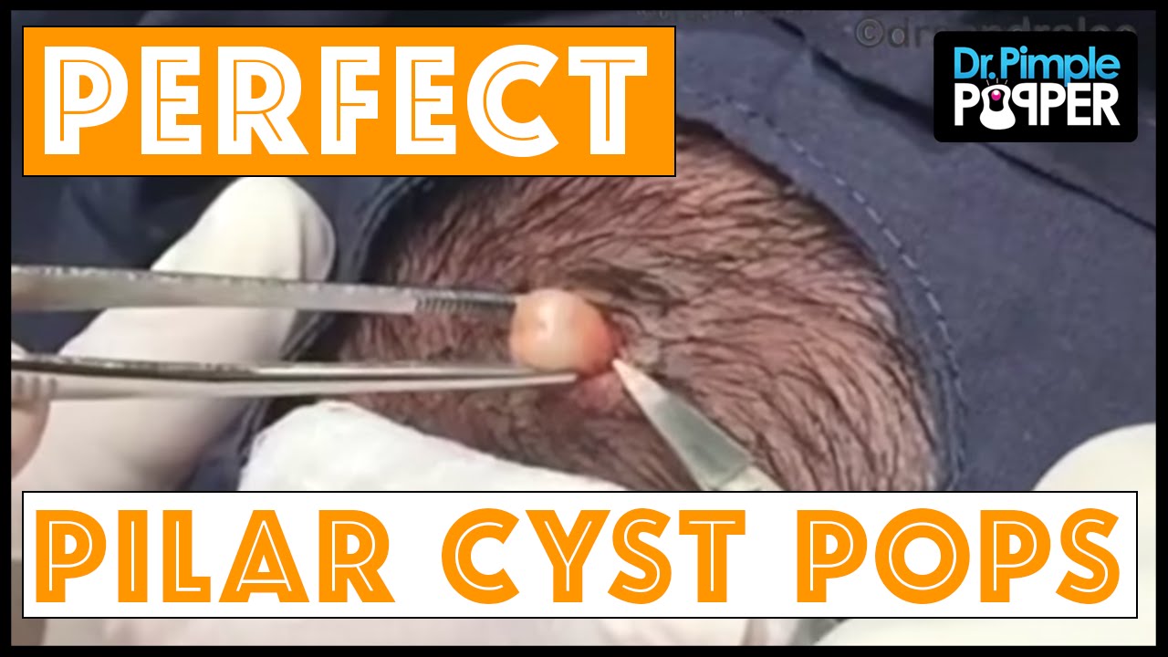 Pilar Cysts Come in All Shapes & Sizes: a FBF😜 Compilation