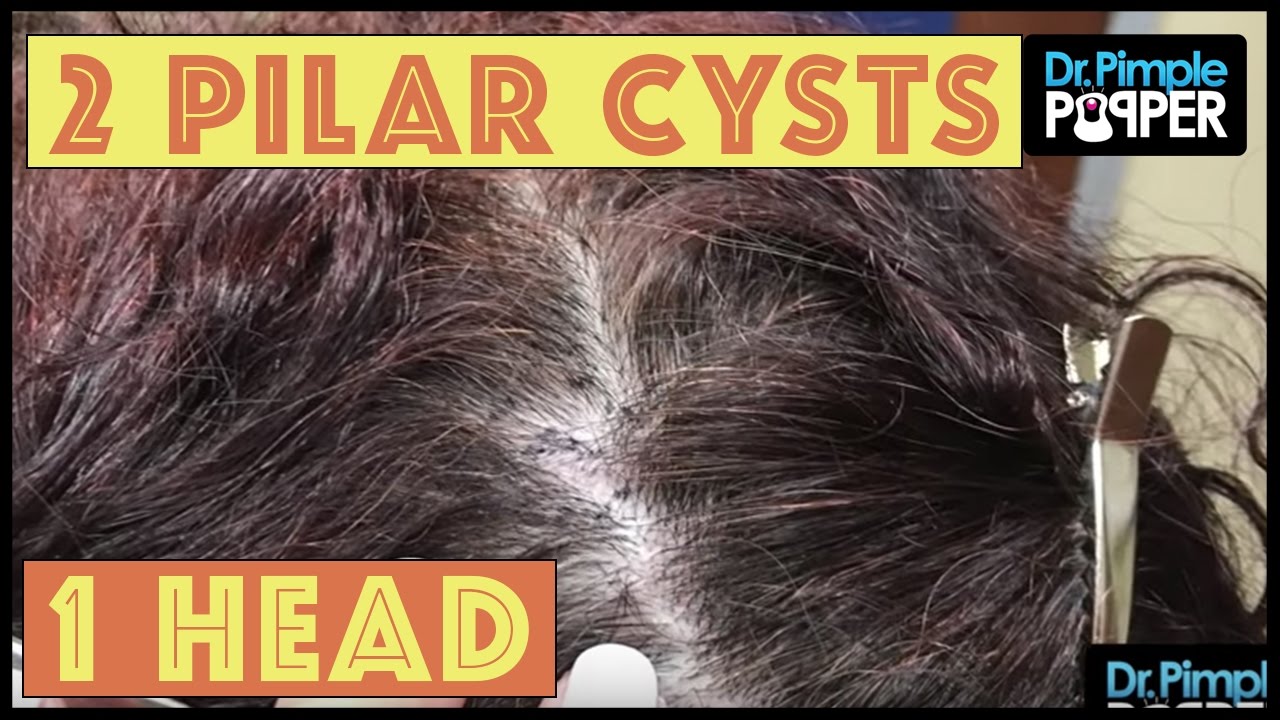 Pilar cysts – one squeeze, one intact!