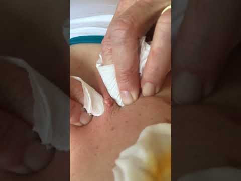 Pimple/Cyst Popping !! Wait for the end !