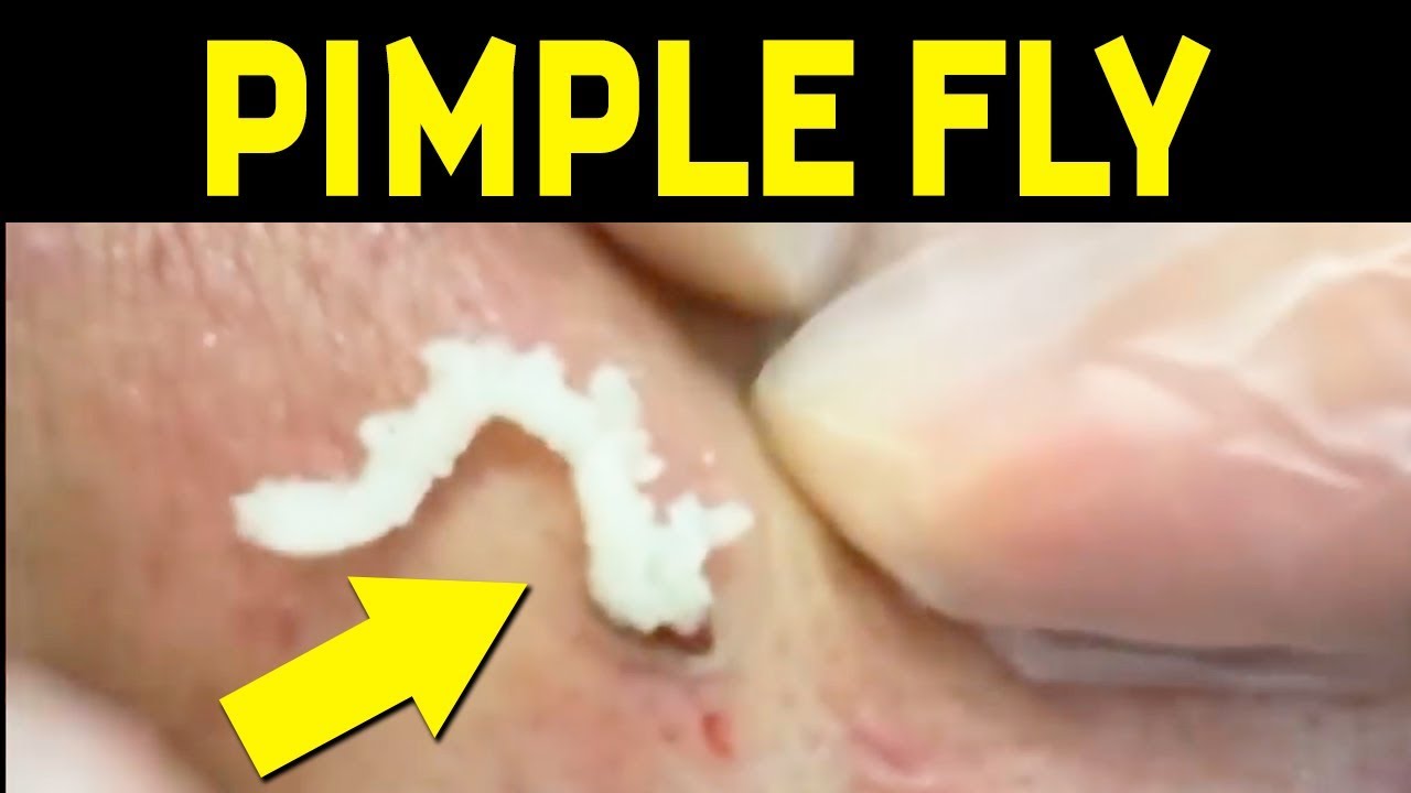 Pimple extraction, Flying Pimple Popping