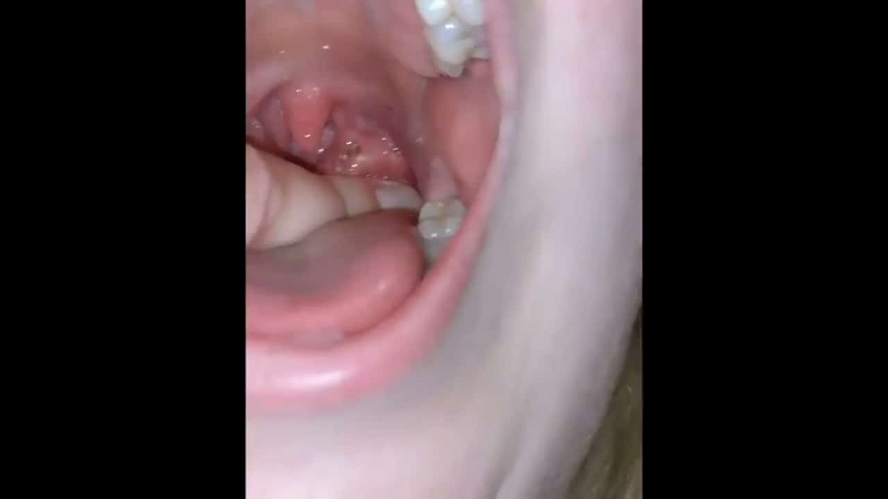 pimple in mouth #satisfying #satisfyingvideo